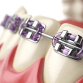 Braces Cheap Braces in Tijuana