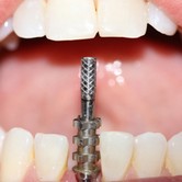 Dental Implants Low Cost Dental Implants In Tijuana